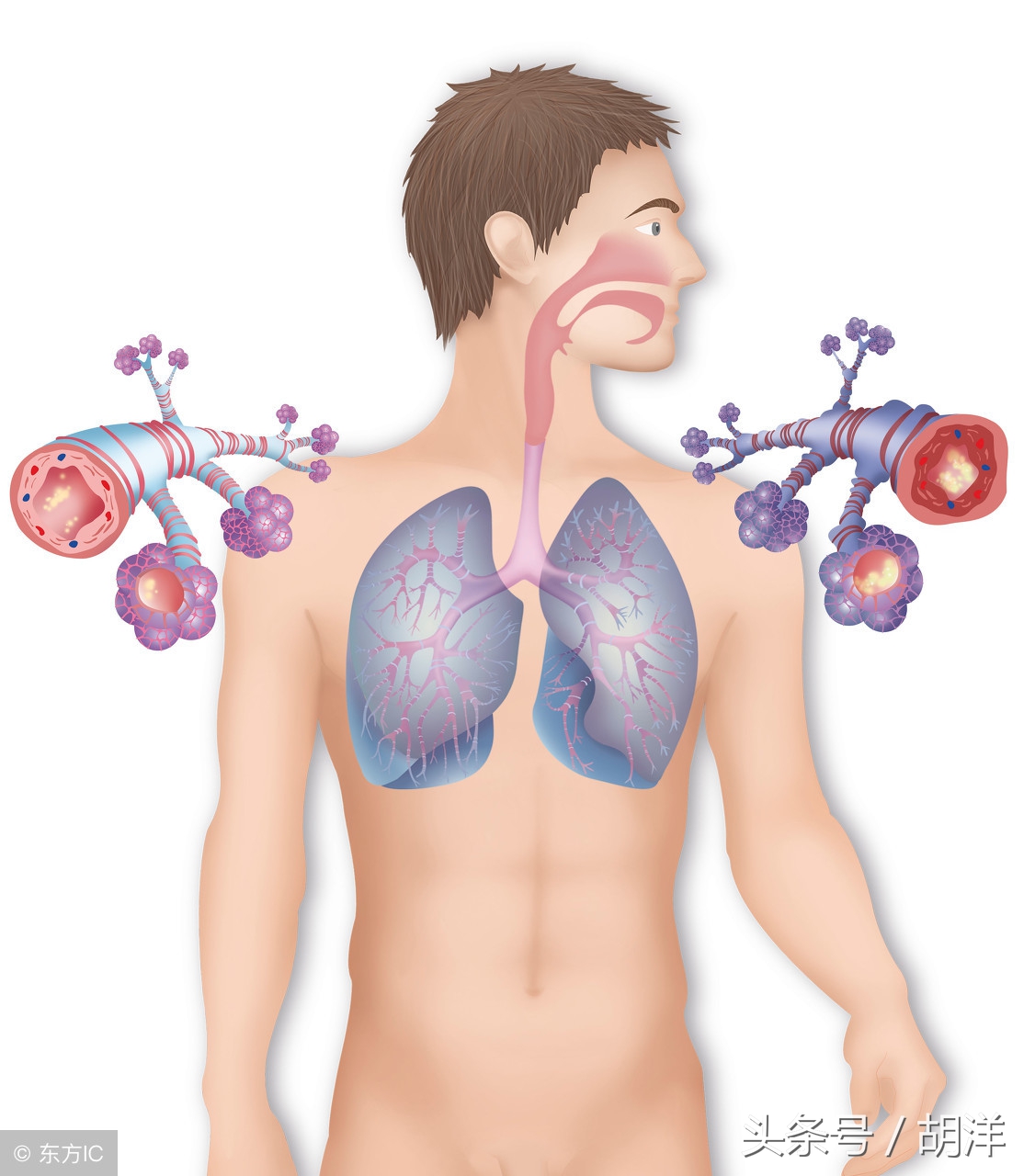 支气管扩张可以完全治愈吗,支气管扩张能根治吗