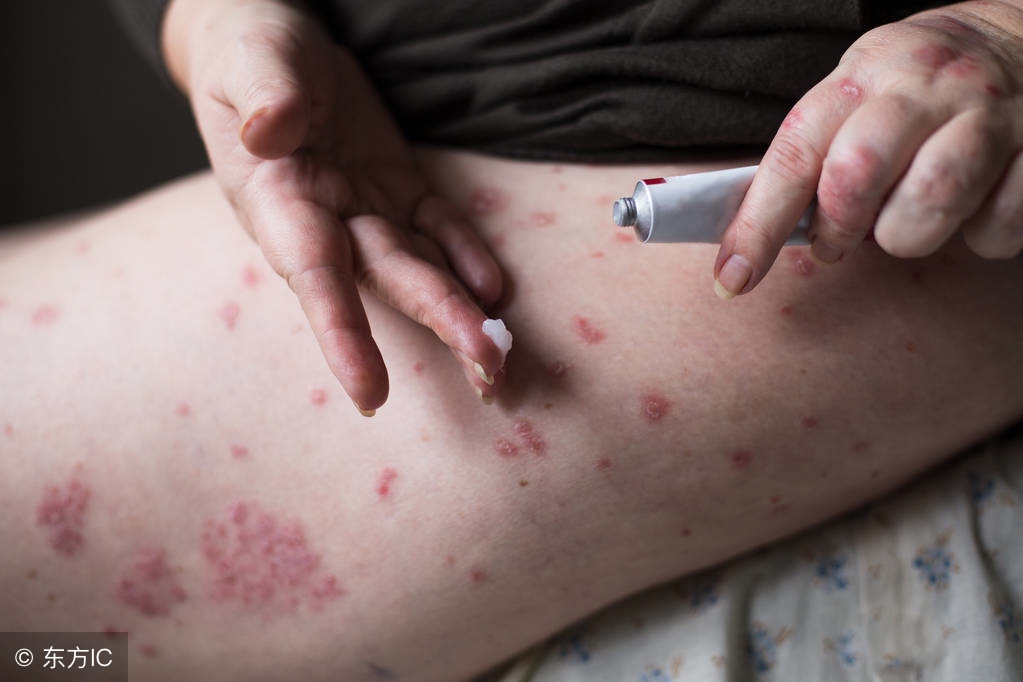 尖锐湿疣在感染的时候具有潜伏期,发病时有何症状