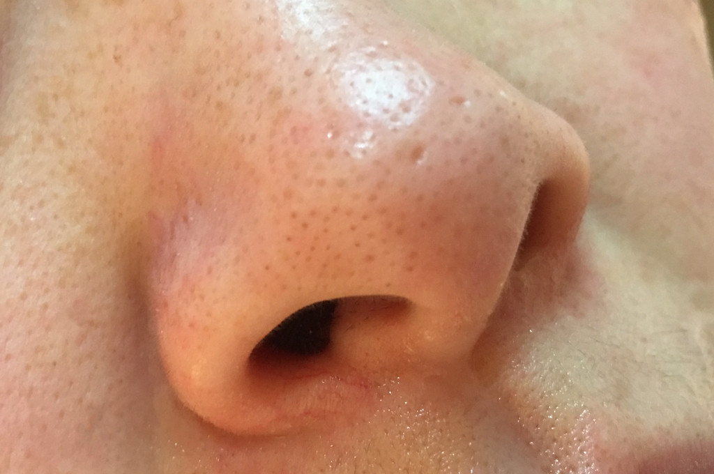 去黑头收缩毛孔简单有效方法,去黑头收缩毛孔简单小方法