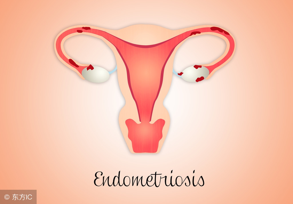 产后有子宫内膜炎怎么办,产后康治疗子宫内膜炎