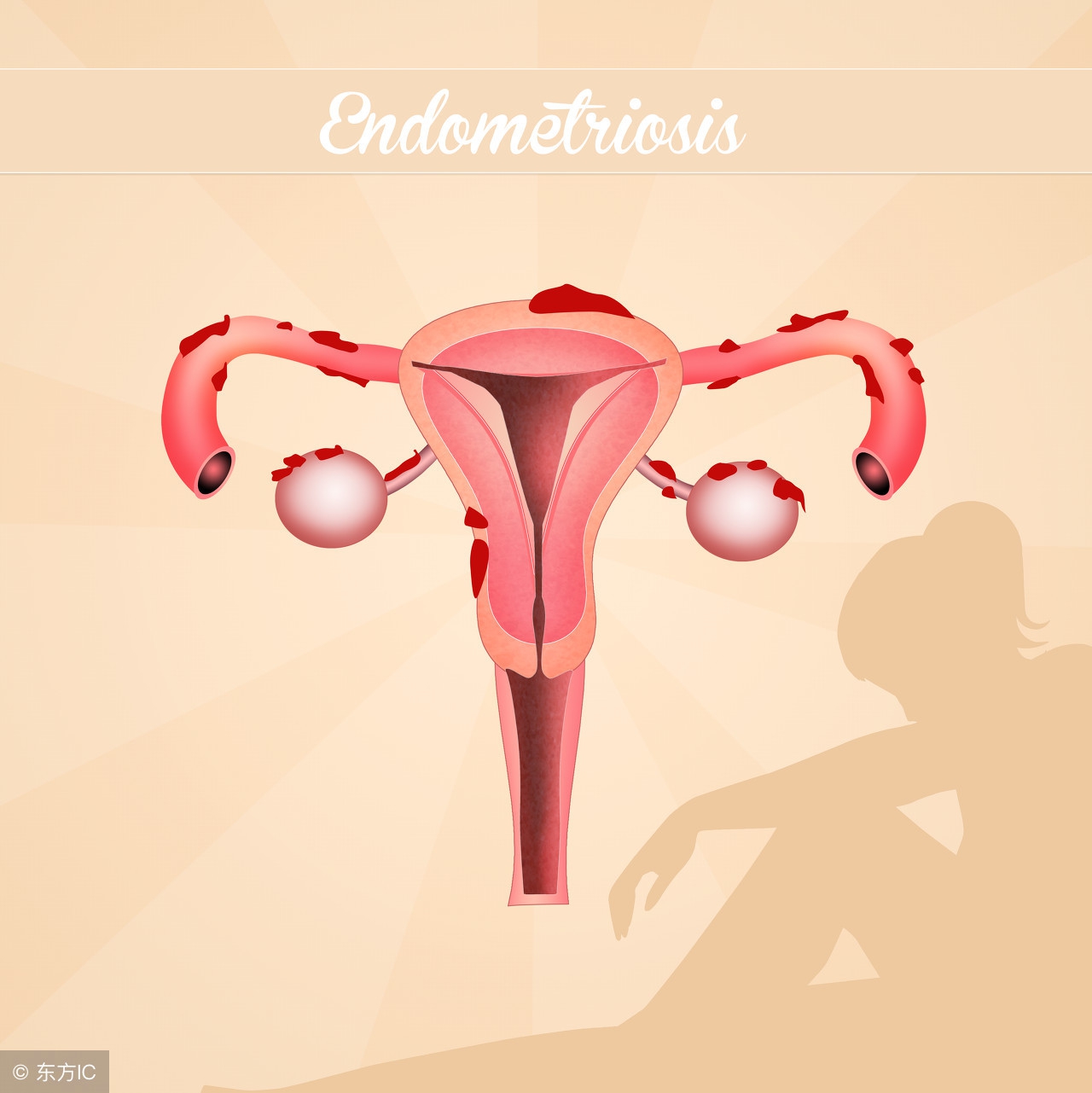 产后有子宫内膜炎怎么办,产后康治疗子宫内膜炎