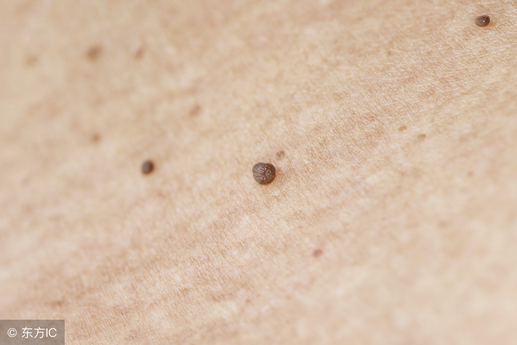 扁平疣擦药膏后脱皮是要好症状吗,皮肤病扁平疣的症状是什么