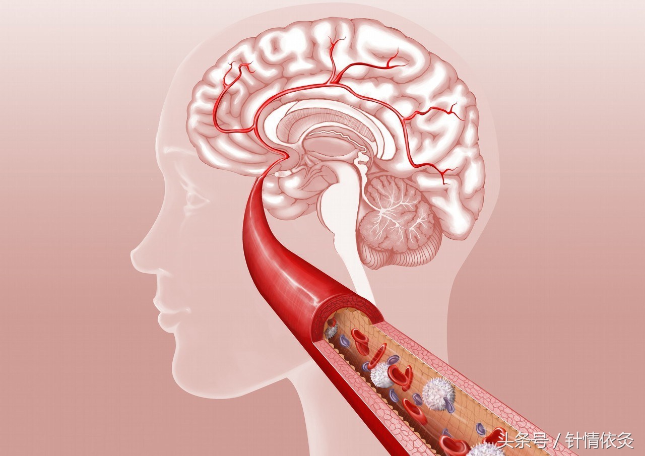 针灸治疗脑出血后遗症选穴机理,手掌针灸能治脑出血半身麻吗