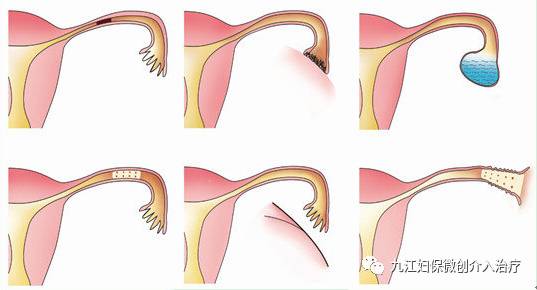 输卵管臭氧介入治疗和造影剂,介入治疗输卵管堵塞需要打麻药嘛