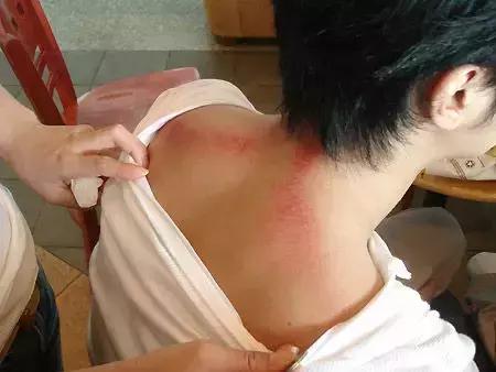 刮痧治疗感冒的操作流程,风寒感冒刮痧哪里效果最好图解