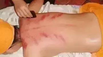 刮痧治疗感冒的操作流程,风寒感冒刮痧哪里效果最好图解