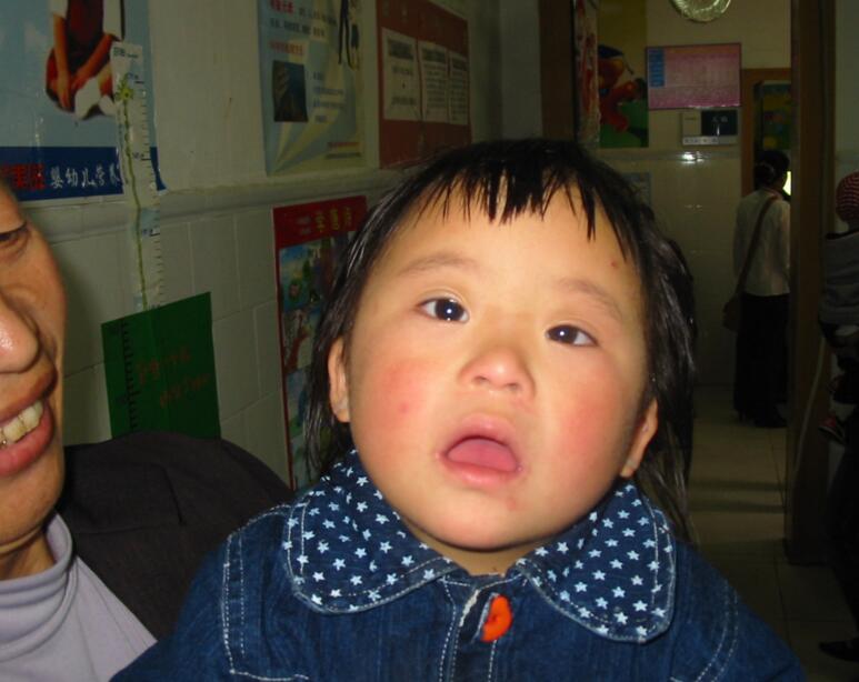 无创dna羊水穿刺会导致流产吗,羊水穿刺的风险和危害