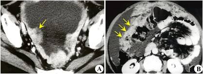 4种癌症影响女人一生健康!