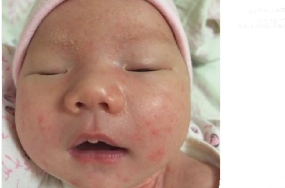 宝宝湿疹妈妈饮食应该注意什么,孩子长湿疹妈妈需要注意什么