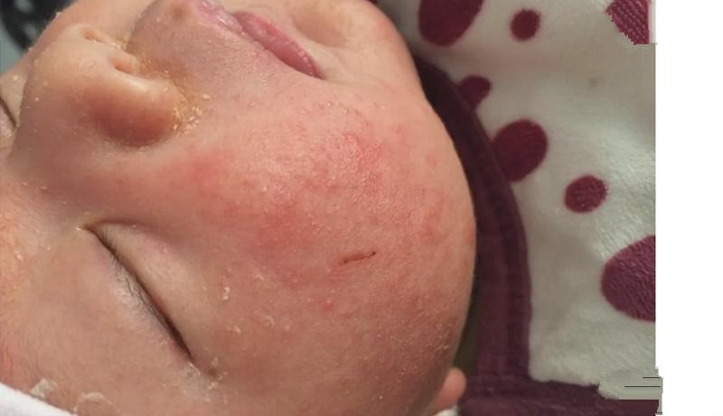 宝宝湿疹妈妈饮食应该注意什么,孩子长湿疹妈妈需要注意什么