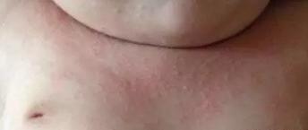 宝宝热疹和湿疹的区别,最简单的热疹和湿疹区别
