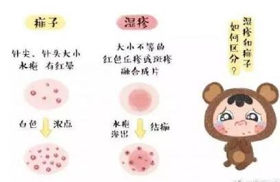 宝宝热疹和湿疹的区别,最简单的热疹和湿疹区别