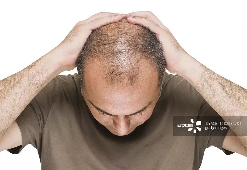 23岁脱发严重m型脱发怎么拯救,脱发斑秃脂溢性脱发