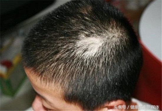 俗称的鬼剃头是什么原因造成的,民间说法的鬼剃头是什么意思