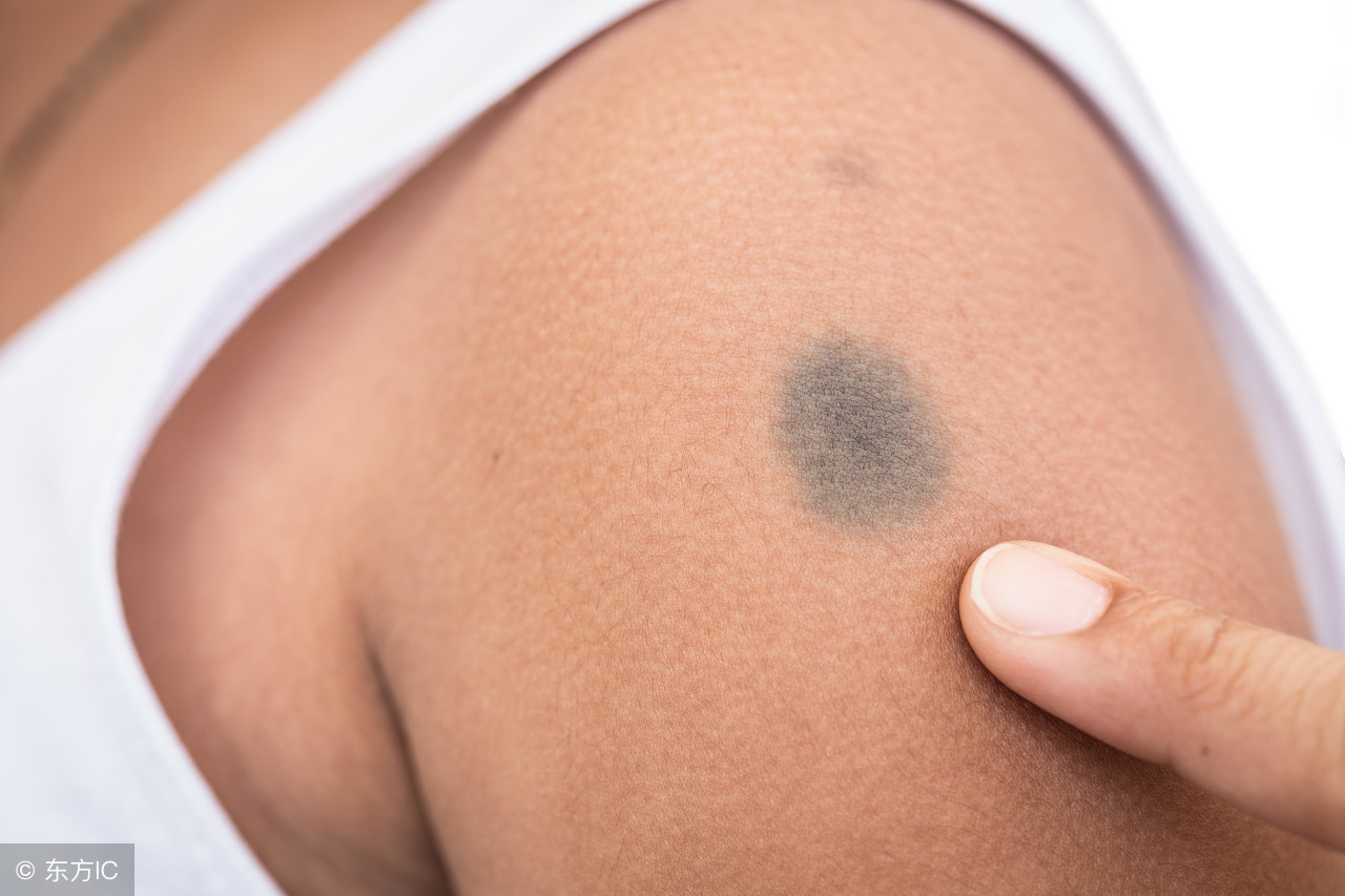 黑色素瘤的治疗方法有哪些,黑色素瘤治疗方法有哪些