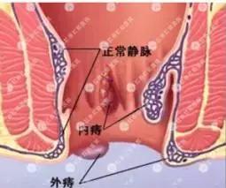 便血的科普文章,关于痔疮科普的主题