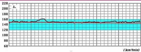 胎心监护曲线太平稳是什么原因,胎心监护曲线起伏不大怎么回事
