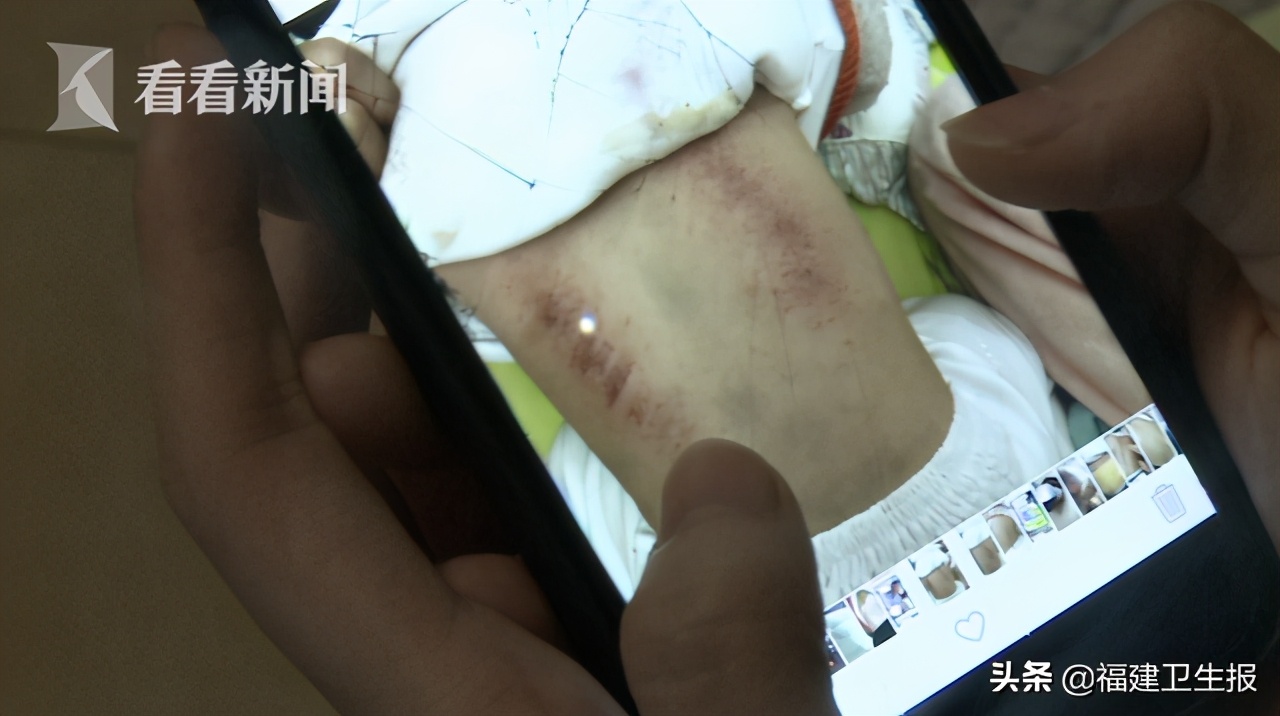 儿童泡过药浴全身像过敏一样,1岁宝宝泡药浴起疹子