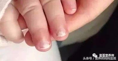 宝宝指甲白斑、凹陷、扁平、分层、脱皮别不在意，有的提示重病！
