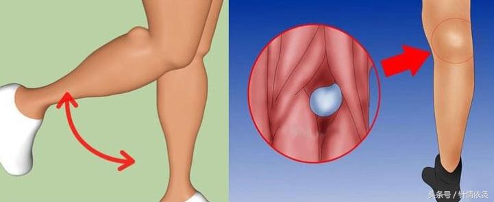 腘窝囊肿针灸拔罐理疗,腘窝囊肿中医针灸可以治好吗