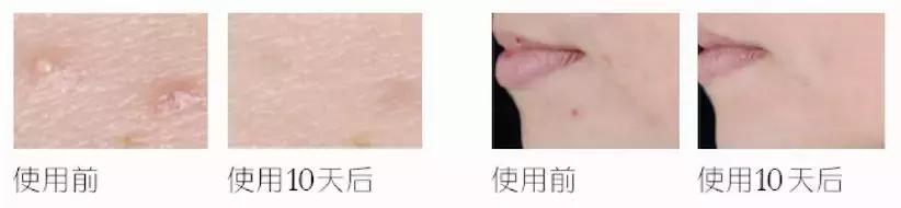 战痘的四个小方法,战痘女孩的秘笈