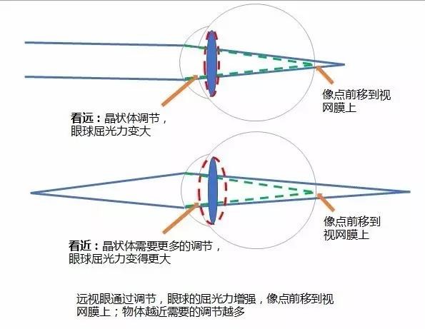 小孩低度近视加散光要怎么矫正,儿童低度近视加散光300要戴眼镜吗