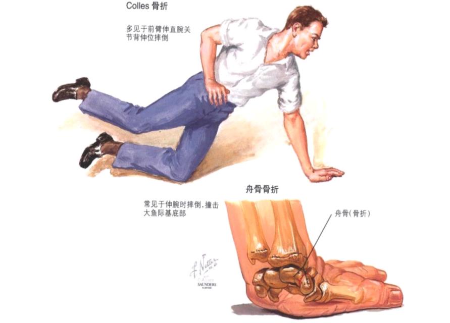 骨科医生讲解骨折怎么恢复,骨科医生手腕骨折正骨