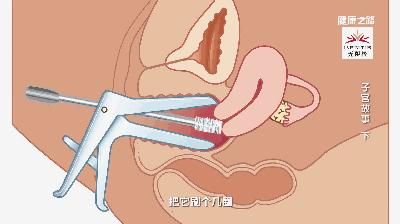 妇科肿瘤最严重的癌,发病率最高的妇科癌症