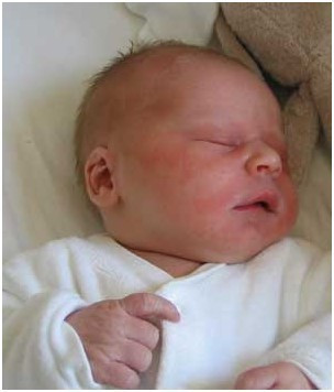 孕妇怎么预防新生儿溶血症,怀孕溶血孕前怎么治疗