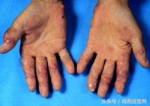 痛风患者可以吃海带和紫菜吗,海带对尿酸高痛风的疗效如何