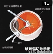 黄斑变性是致盲率非常高的眼病吗,近视性黄斑劈裂图片