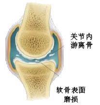换季关节疼痛解决最好办法,冬季关节疼痛如何防治