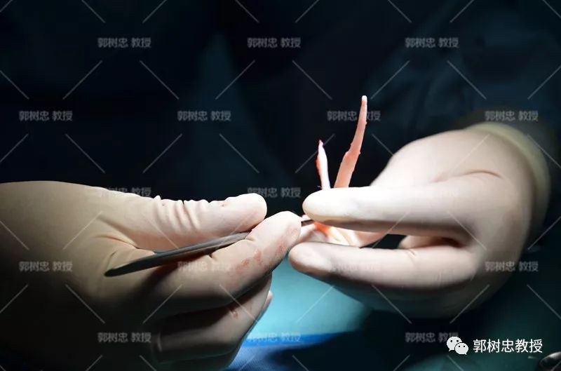 小耳症那些事儿（二十二）再造耳朵的厚度