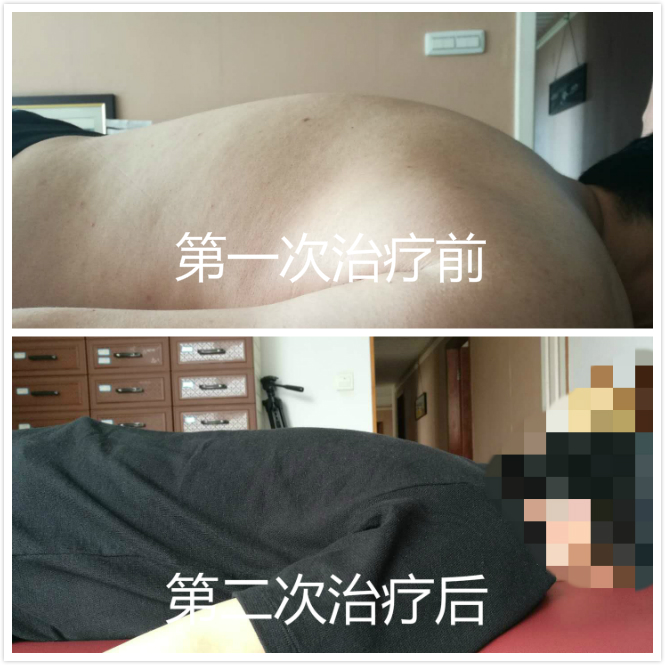 弯驼腰最好的治疗方法,弓腰驼背成人怎么矫正