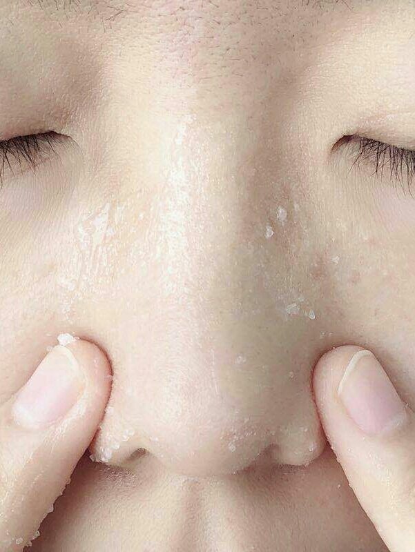 小孩黑头怎么去除最有效的方法,脸上黑头粉刺毛孔粗大怎么去除