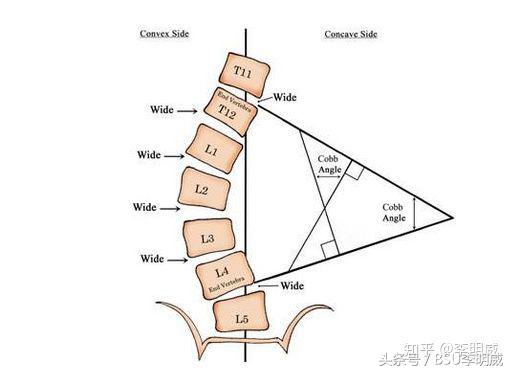 腰椎侧弯怎么办,胸腰椎侧弯是怎么回事