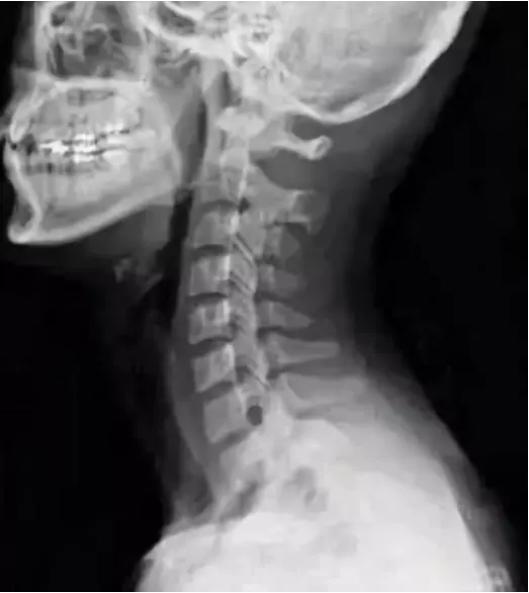 滑肩富贵包快速消除方法,厚背圆肩富贵包怎么消除