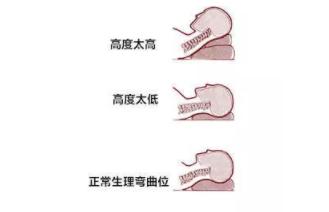 滑肩富贵包快速消除方法,厚背圆肩富贵包怎么消除