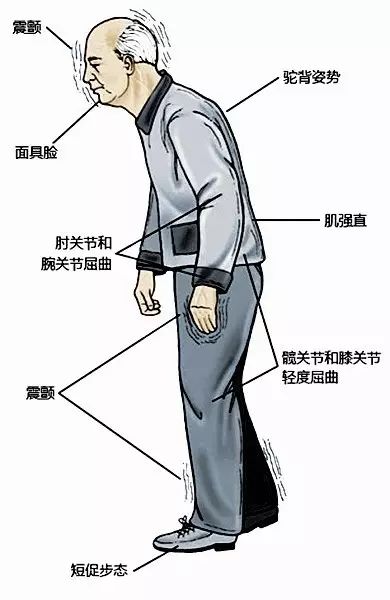 「专家讲健康」康复中心戚成奎主任：手会抖是怎么一回事？