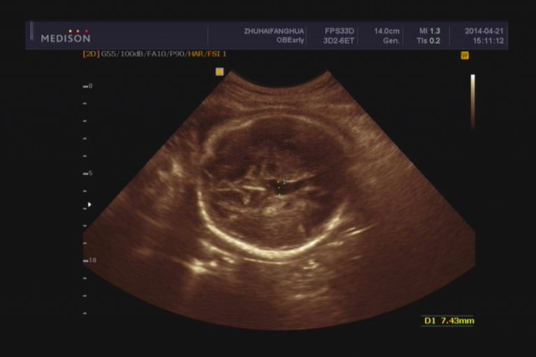 早产儿颅内出血脑积水脑室扩张,胎儿脑室扩张好还是不好