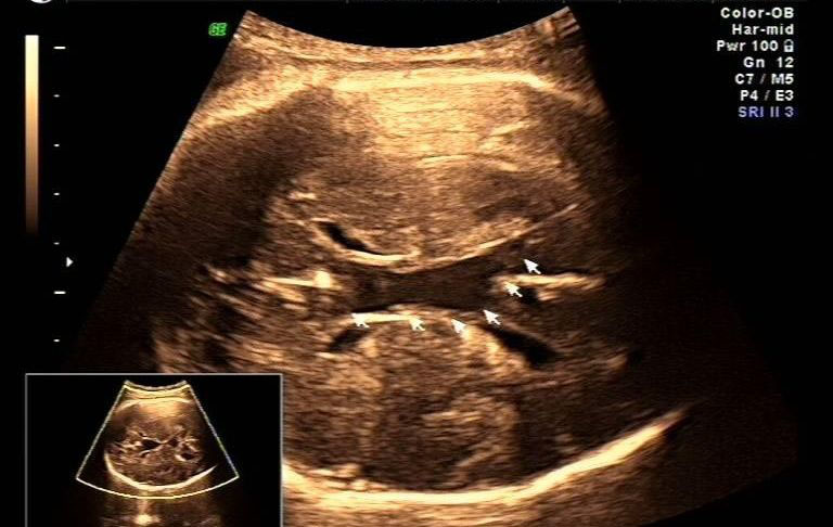 早产儿颅内出血脑积水脑室扩张,胎儿脑室扩张好还是不好