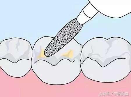 六龄齿生长周期,六龄齿是每个人都有的吗