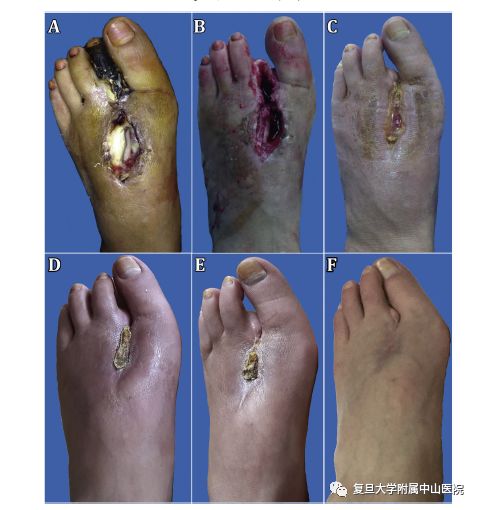 干细胞技术竟然可以“生死肉骨”？！中山医院自体干细胞移植治疗难治性重度肢体缺血