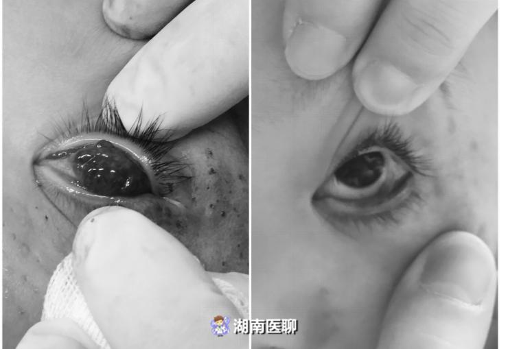 新生儿脸上有褐色胎记可以去掉吗,新生儿脸上红色的胎记能处理吗