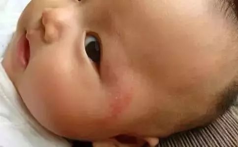 痒痒的皮肤怎么治疗,儿童秋季皮肤干燥发痒怎么办