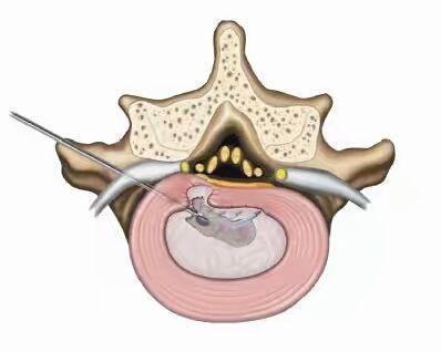 腰椎间盘突出激光汽化手术缺点,腰椎间盘突出的骨刺能用激光吗