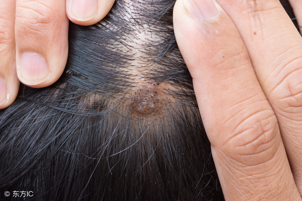 头发老掉是头皮有螨虫的原因吗,头发出油是螨虫的原因吗