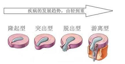 腰椎4.5突出压迫坐骨神经疼怎么办,腰椎间盘突出症神经治疗