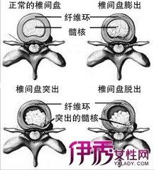 腰椎4.5突出压迫坐骨神经疼怎么办,腰椎间盘突出症神经治疗
