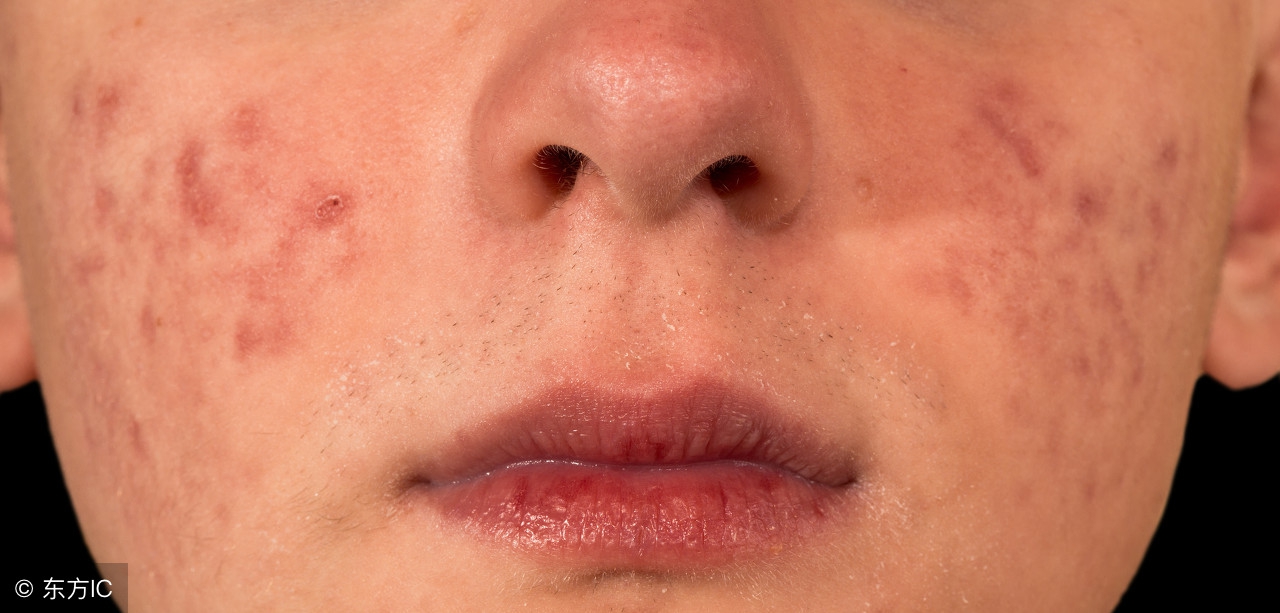 怎么区分痘痘种类,如何鉴别痘痘种类